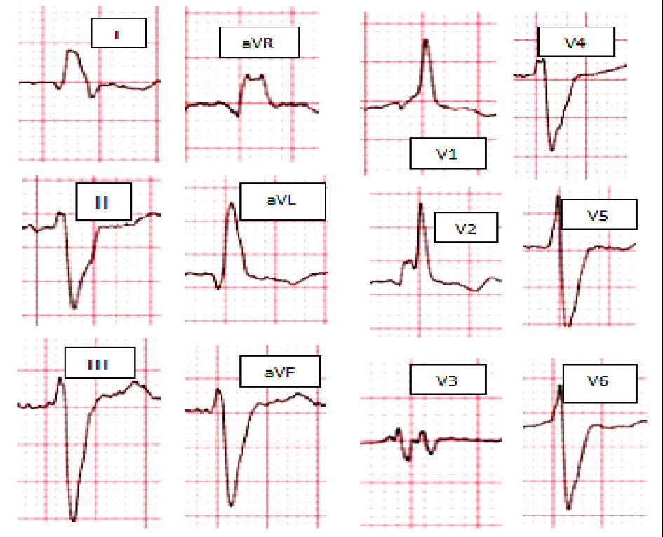 percent of ivcd vs rbbb crt